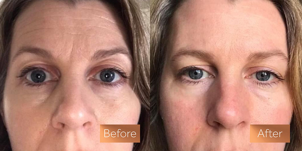 Collagen Supplements Before and After: What to Expect