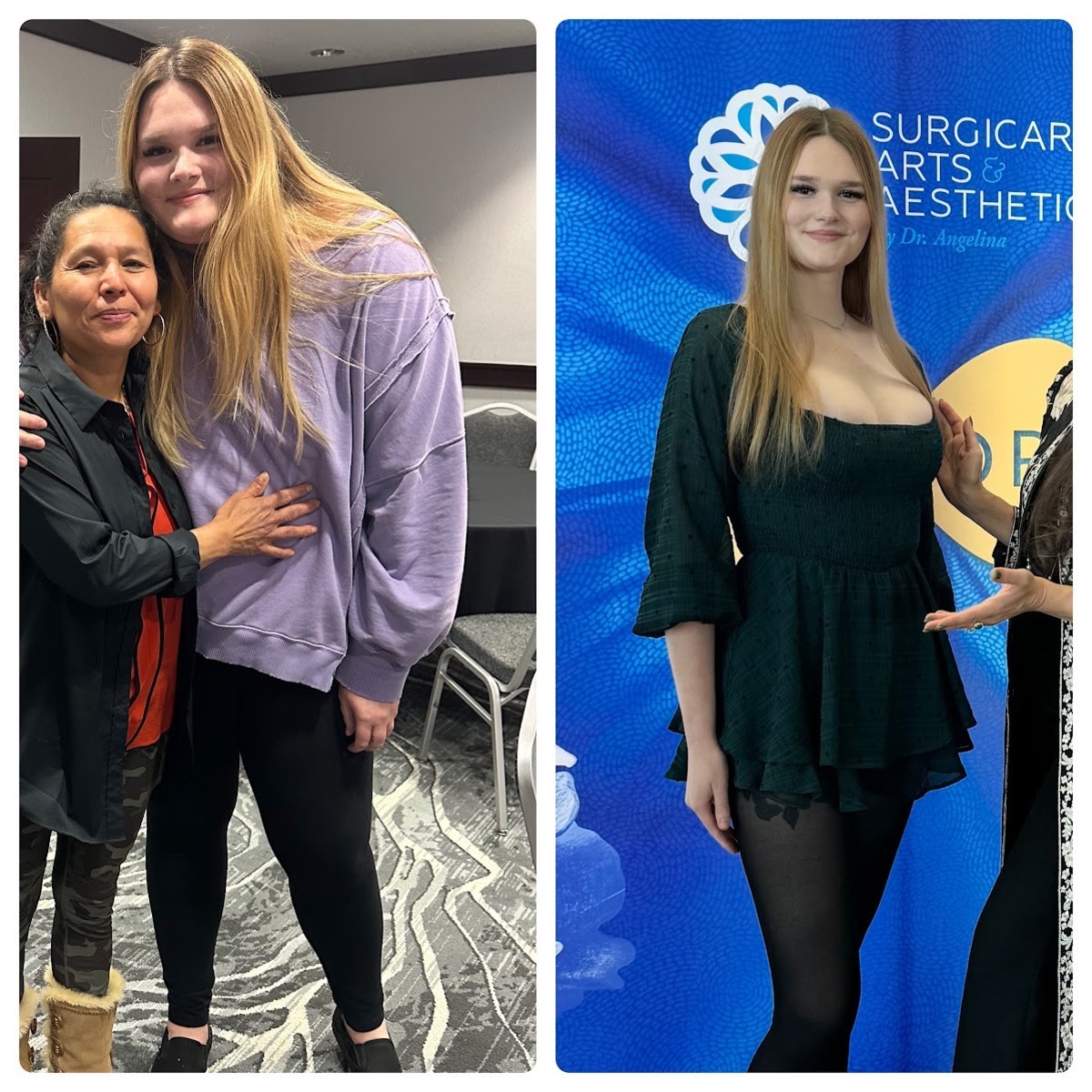 Thinking About Ozempic? See These Before and After Results First!