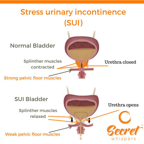 Is it normal for someone to pee pants a little bit when sneezing? Learning about stress incontinence facts.