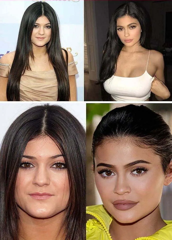 Kylie Jenner Before & After: How Her Face Changed So Much