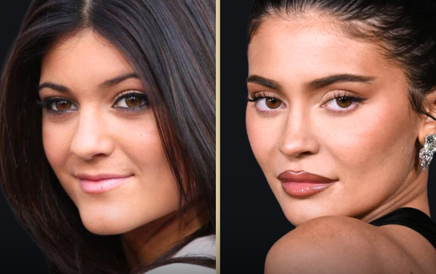 Kylie Jenner Before & After: How Her Face Changed So Much